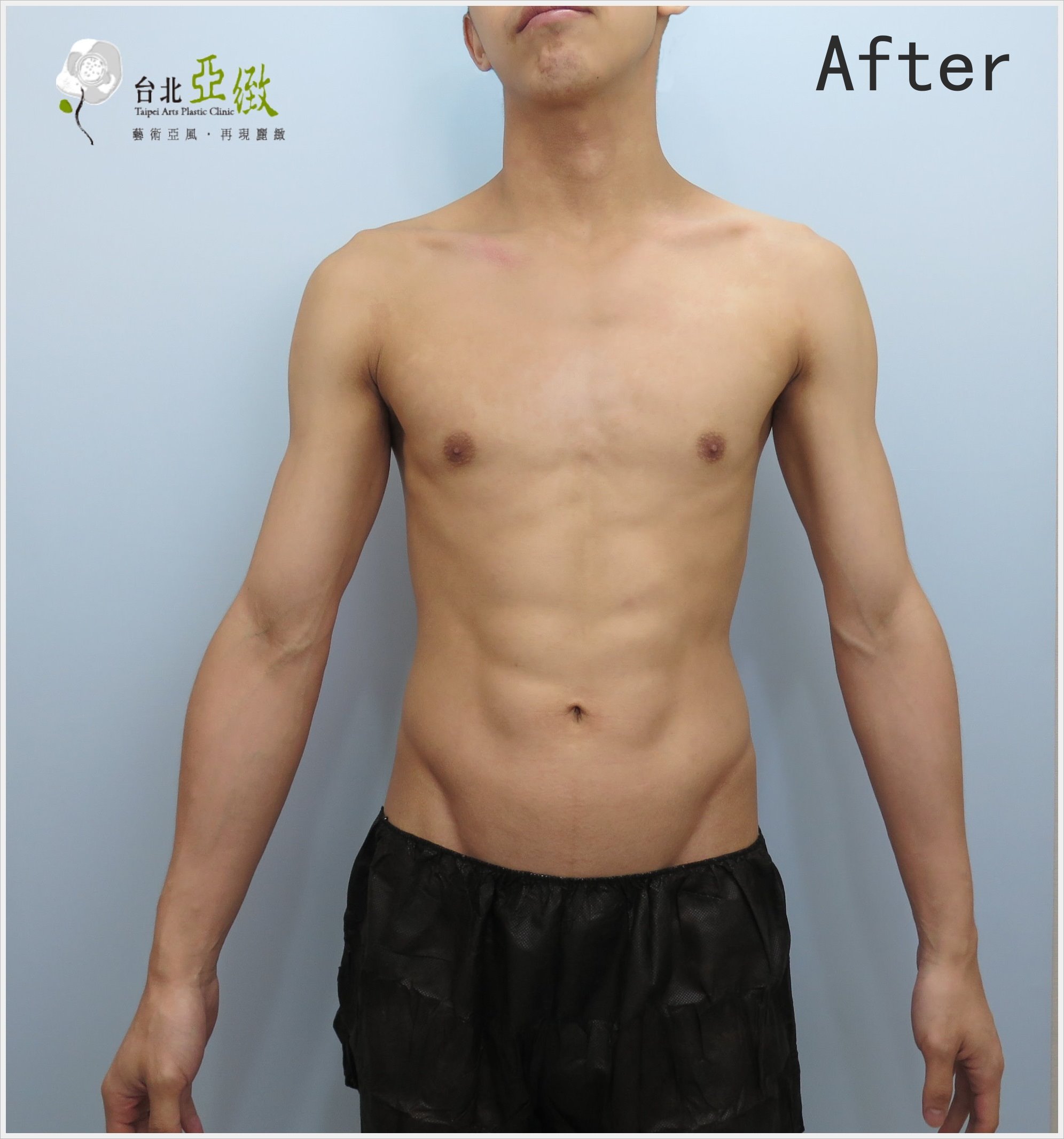 威塑抽脂 大肚男二代威塑六塊肌 手術後