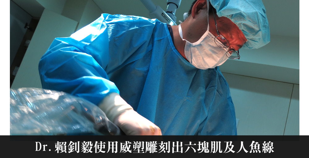 威塑抽脂 大肚男二代威塑六塊肌 手術