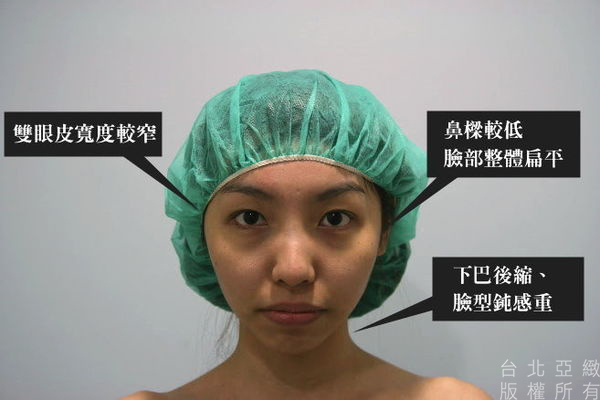 002三段式隆鼻手術術後照顧心得差別照片分享.JPG
