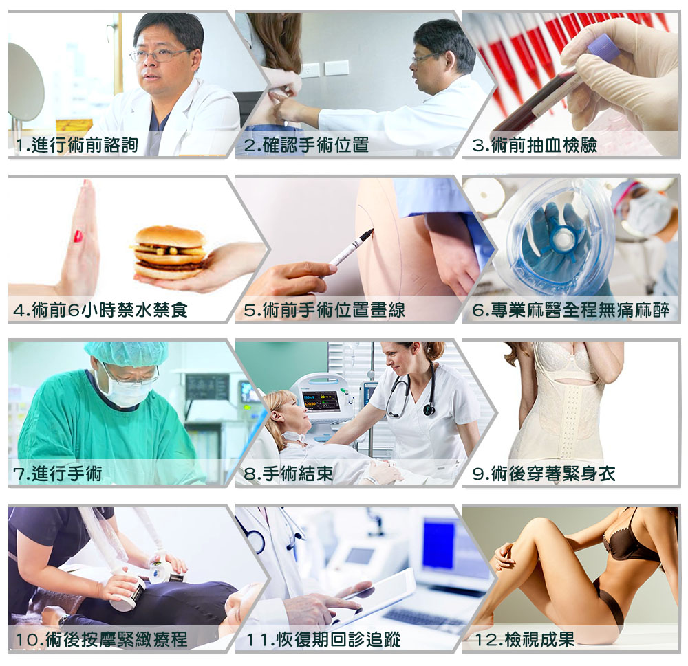 威塑抽脂手術流程