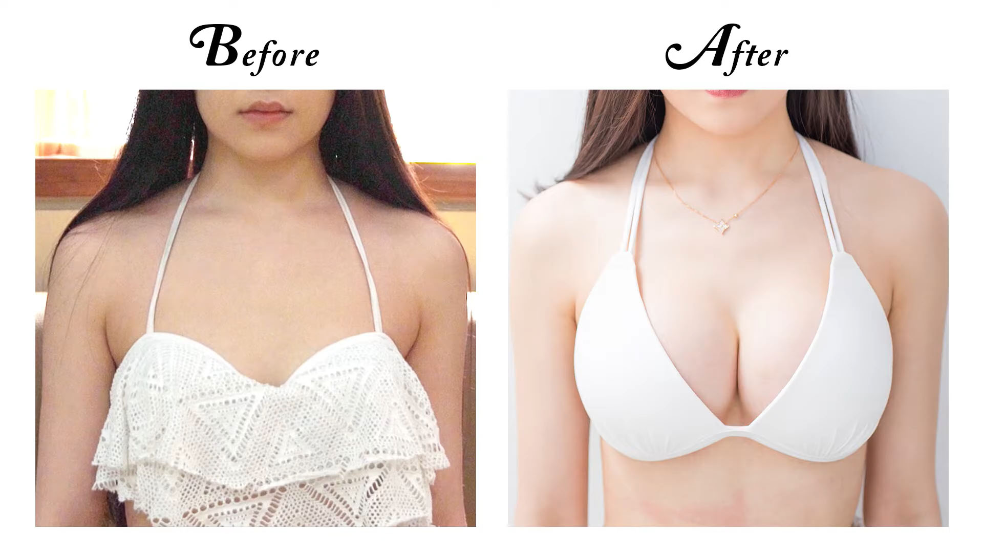 Motiva魔滴隆乳案例