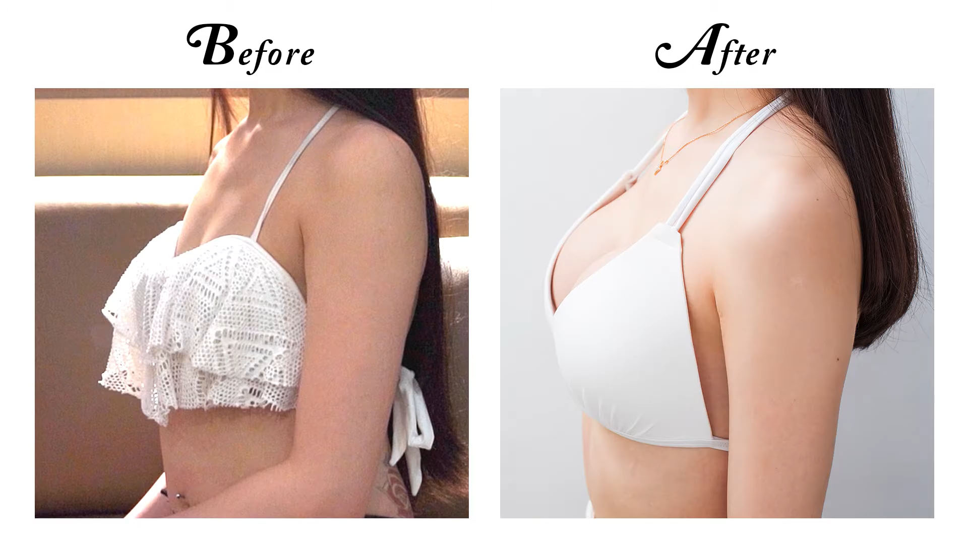 Motiva隆乳案例
