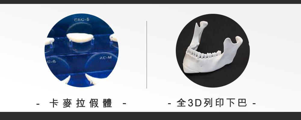 3D墊下巴手術