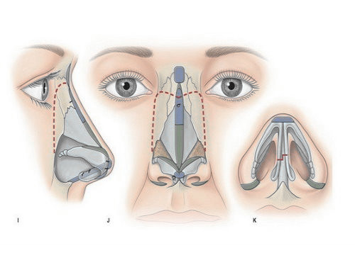 二次隆鼻手術 - 隆鼻失敗鼻部重建 台北亞緻TaipeiArts