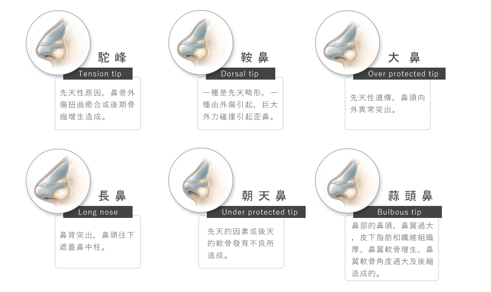 隆鼻手術各種鼻型種類分別