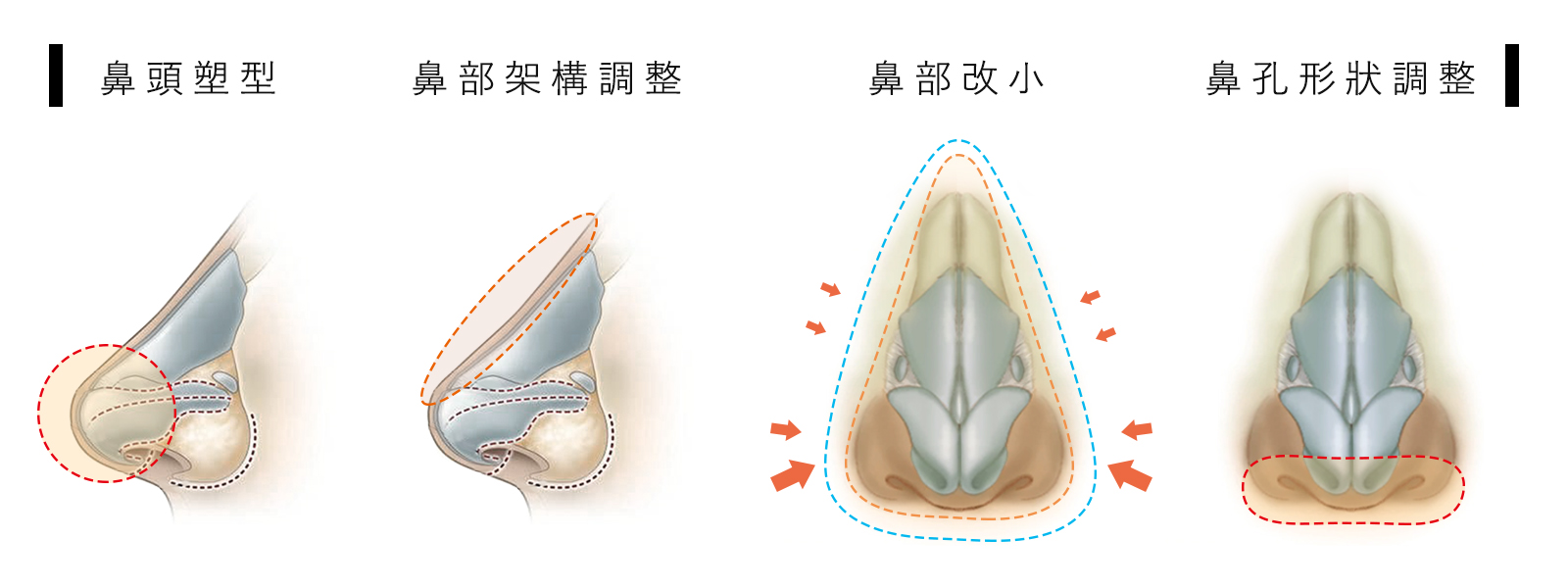 隆鼻手術鼻整形介紹