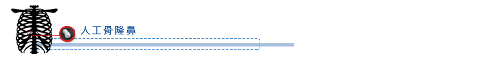 人工骨隆鼻