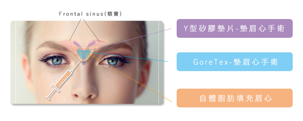 墊眉心手術方式