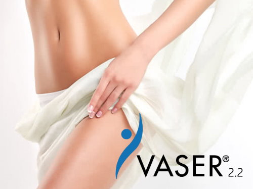 Vaser2.2二代威塑案例照