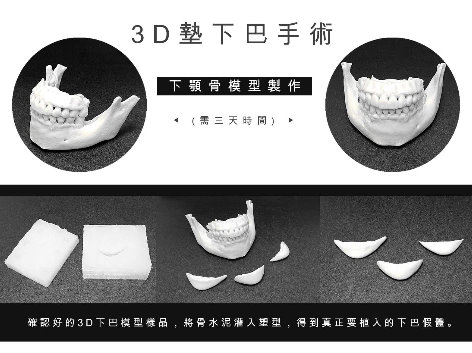 3D列印墊下巴 台北亞緻TaipeiArts