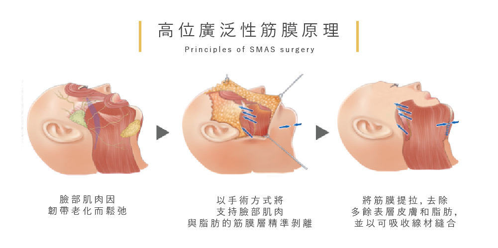 高位廣泛性筋膜（SMAS）提拉