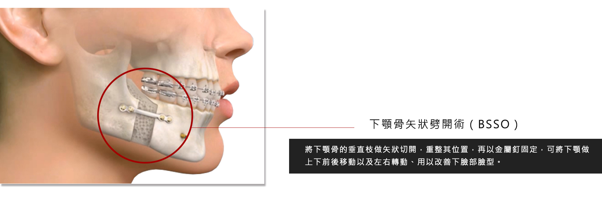 正顎齒顎矯正介紹 怎麼樣才算是成功的正顎齒顎矯正手術 正顎齒顎矯正手術 Motiva魔滴隆乳 Vaser威塑水刀 抽脂 隆鼻下巴整形台北亞緻taipei Arts權威醫師推