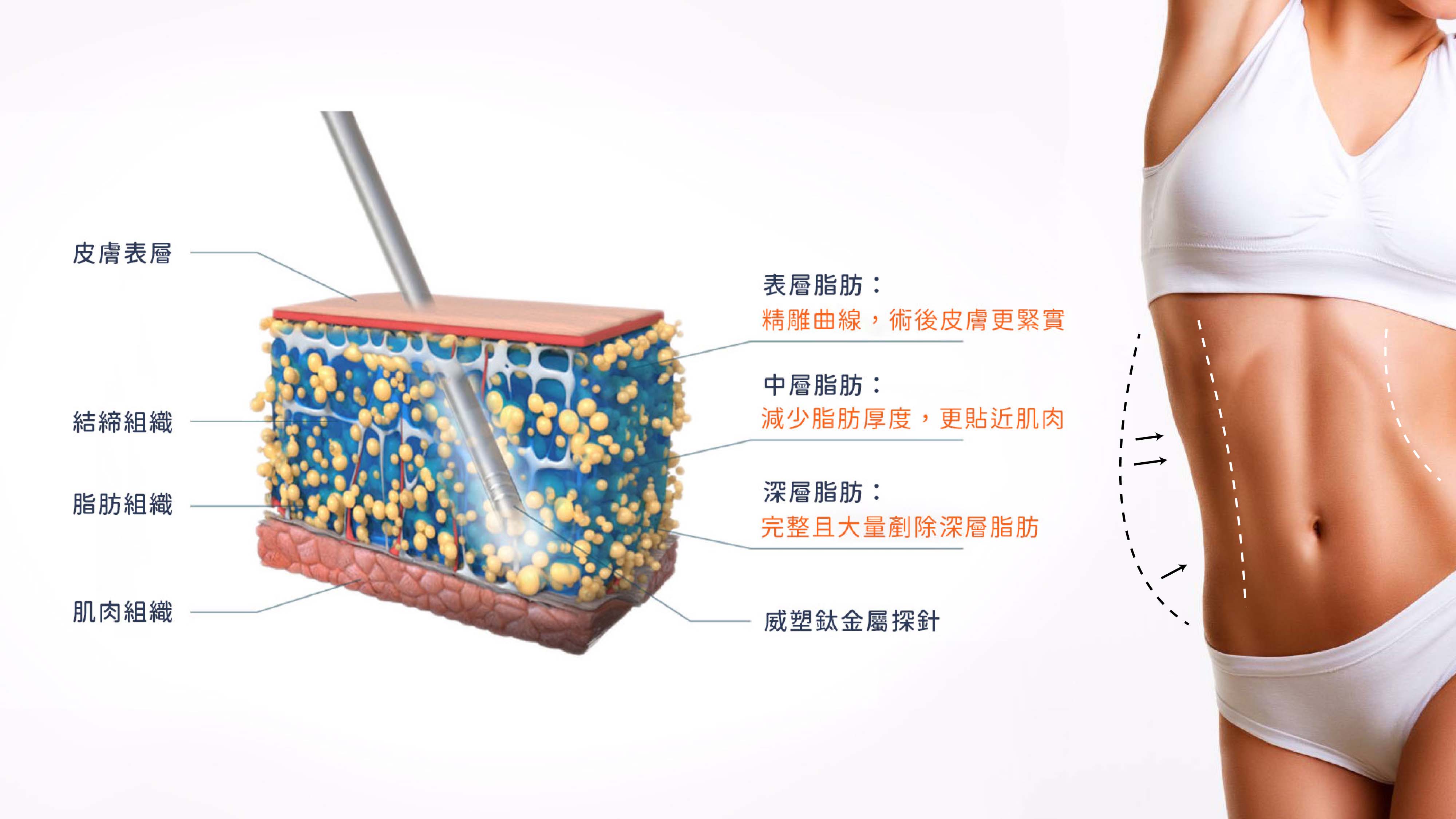 二代威塑抽脂作用原理