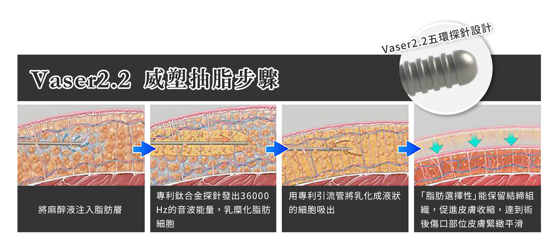 二代威塑抽脂步驟說明