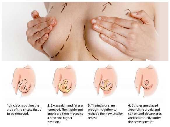 提乳手術疤痕明顯嗎？隆乳提乳可以一次做？新式內提乳手可以疤痕隱痕？費用價格價錢價位說明 台北亞緻Taipe