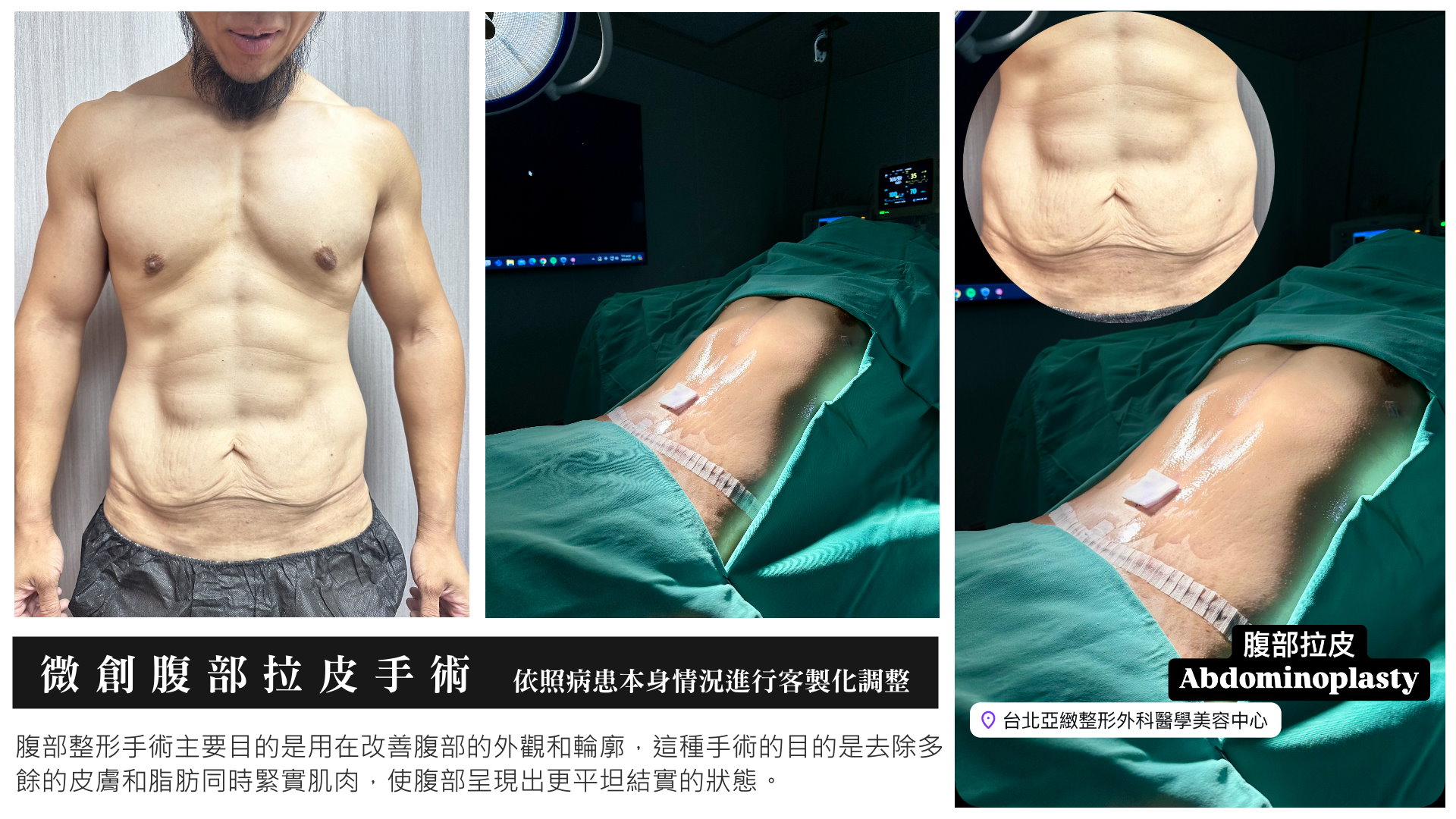 台北腹部拉皮手術吳宗翰醫師