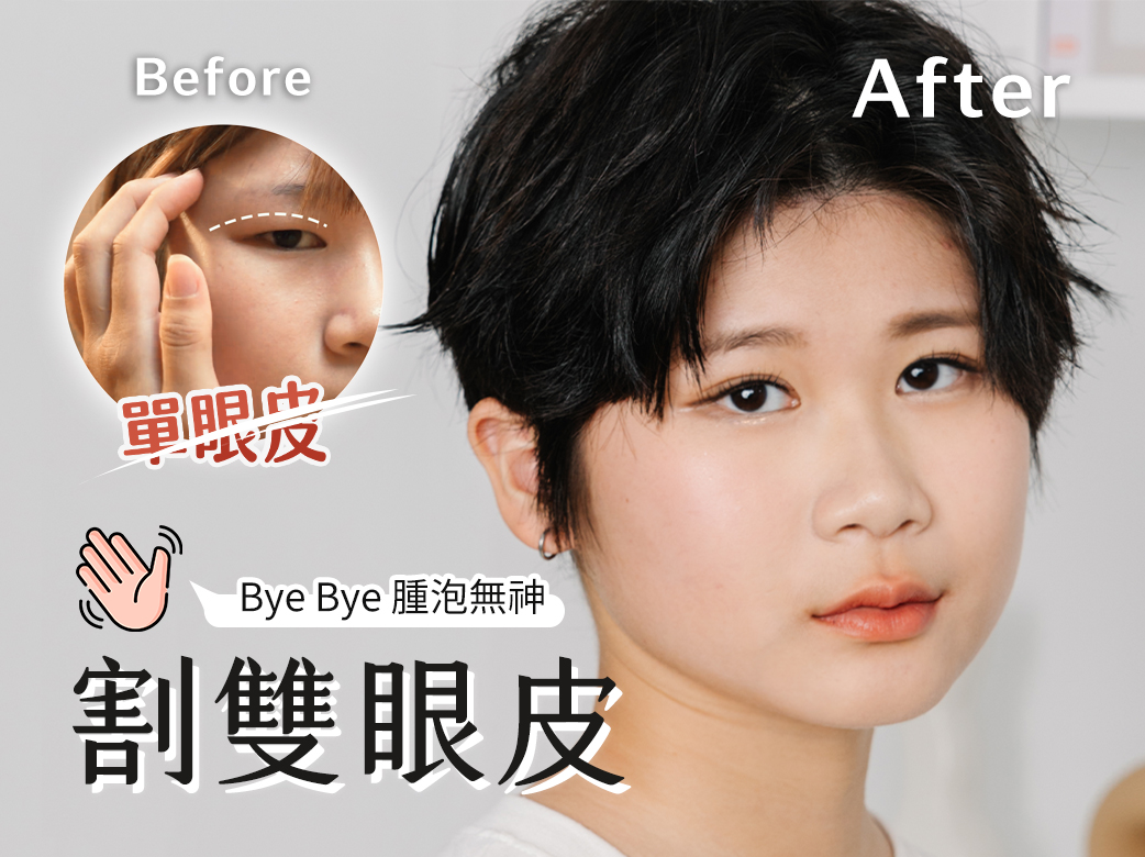 Rita的蛻變記 告別腫泡無神眼皮 迎接亮麗雙眸 割雙眼皮手術
