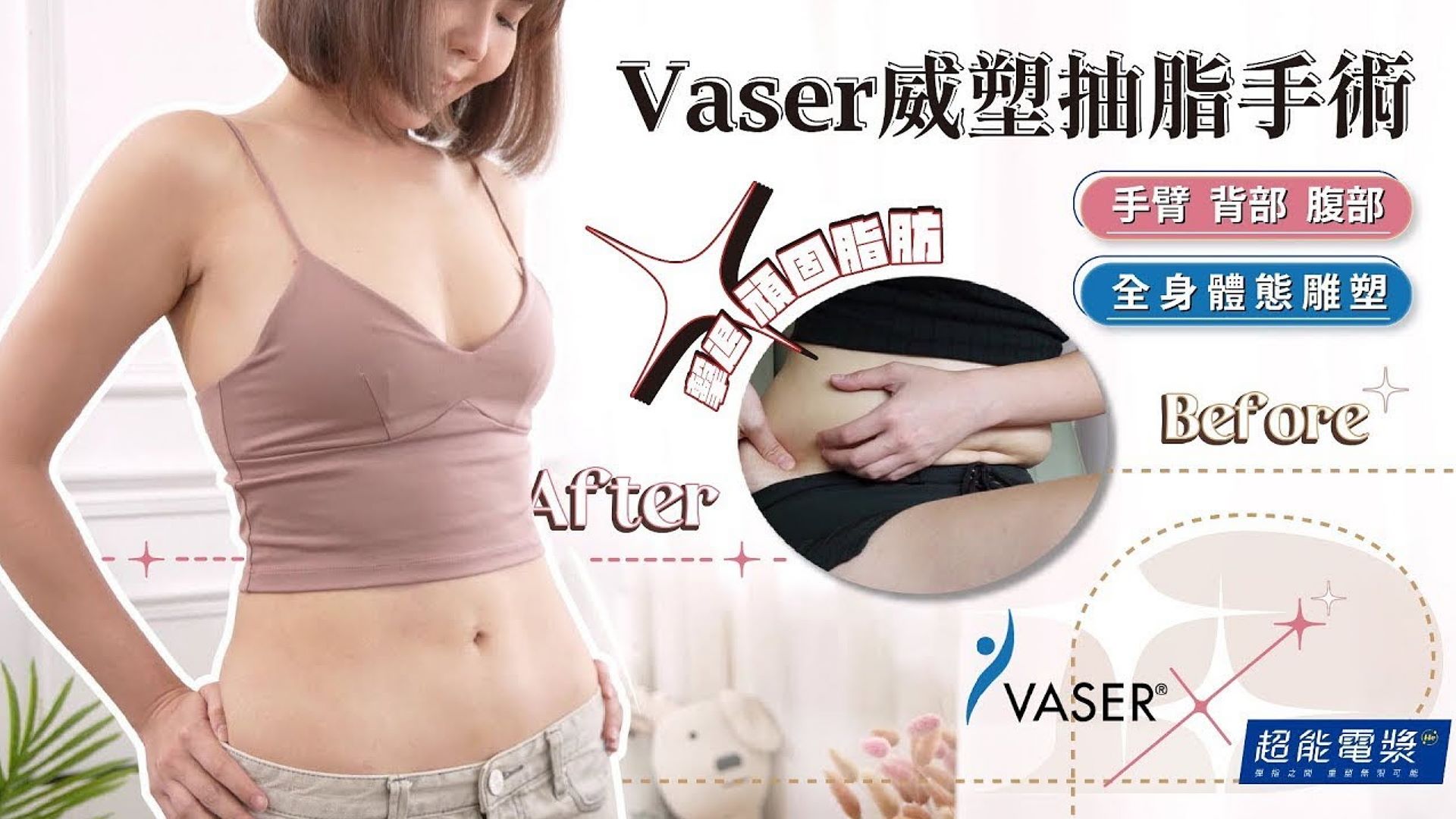 ViVi的曼妙體態後天成形Vaser2.2威塑抽脂手術 台北抽脂亞緻整形TaipeiArt