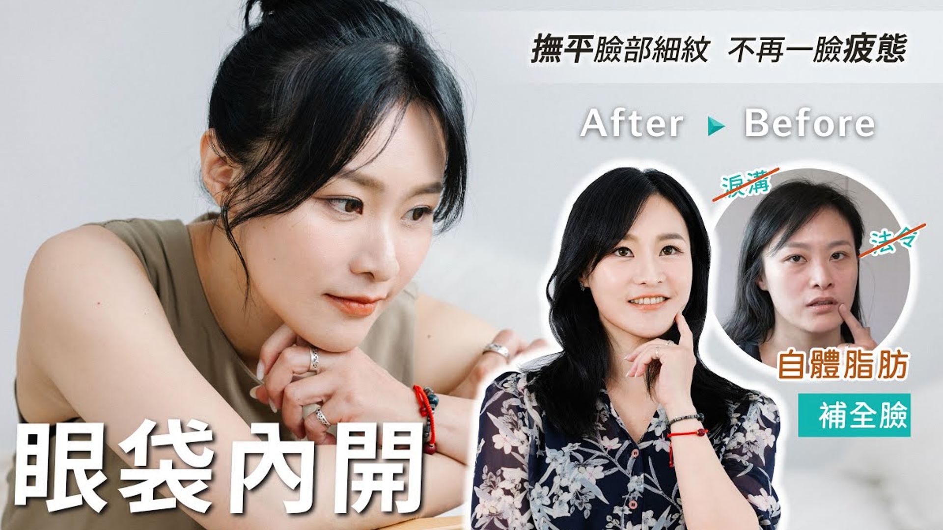 拋開疲憊臉 小妤的美麗蛻變之旅 眼袋內開 自體脂肪補臉 台北眼袋手術 亞緻整形TaipeiArts 謝宇軒醫師