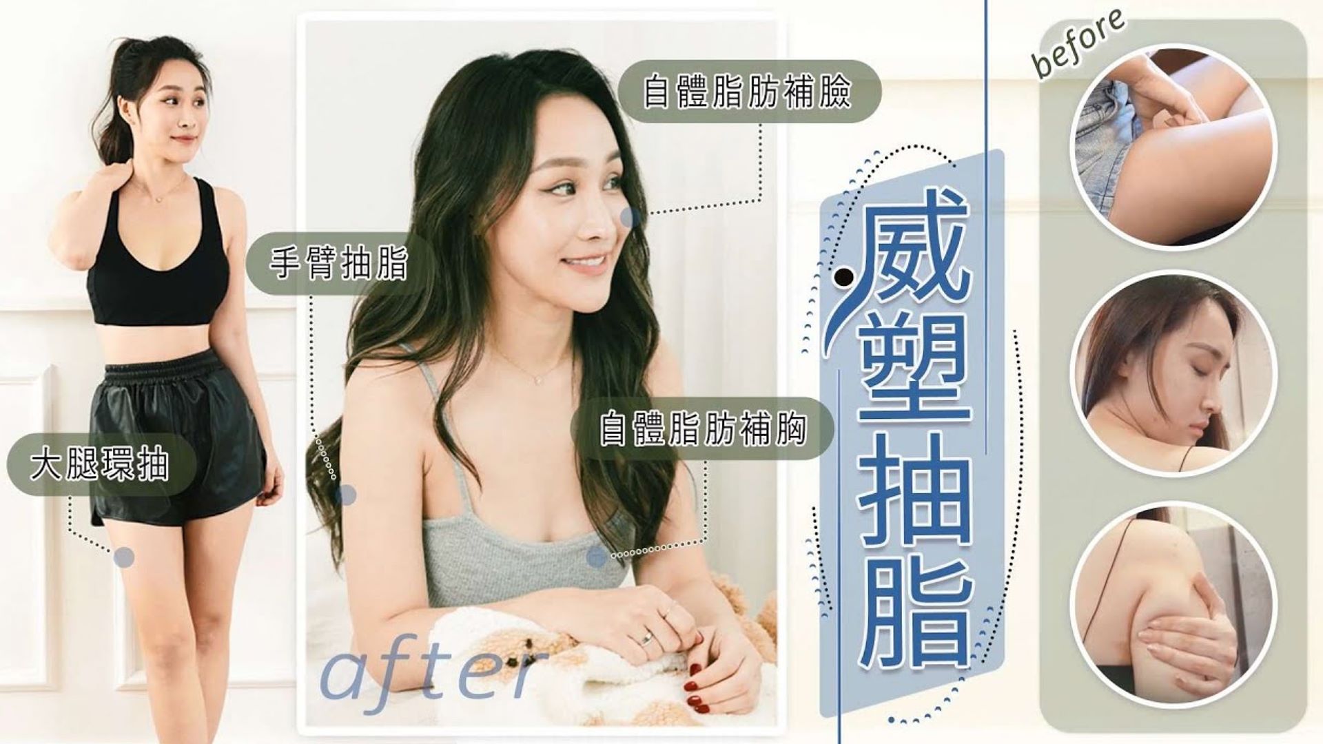 Vaser2.2威塑抽脂、自體脂肪隆乳、自體脂肪補臉、大腿手臂後肩胛副乳抽脂，Chelsea重塑理想身材改善掰掰袖肥胖腿 台北抽脂 亞緻整形TaipeiArts