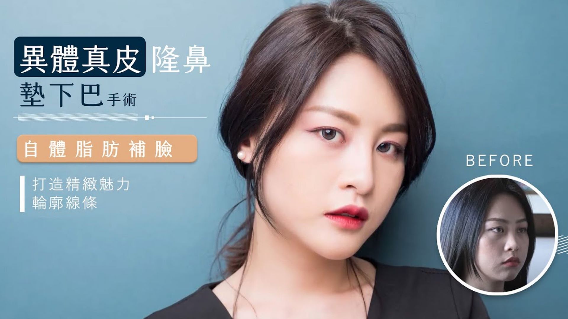 精緻鼻整形隆鼻手術讓五官立體精緻度提升，異體肋骨真皮隆鼻、墊下巴、自體脂肪補臉顏值全面提升 台北亞緻TaipeiArts 謝宇軒醫師