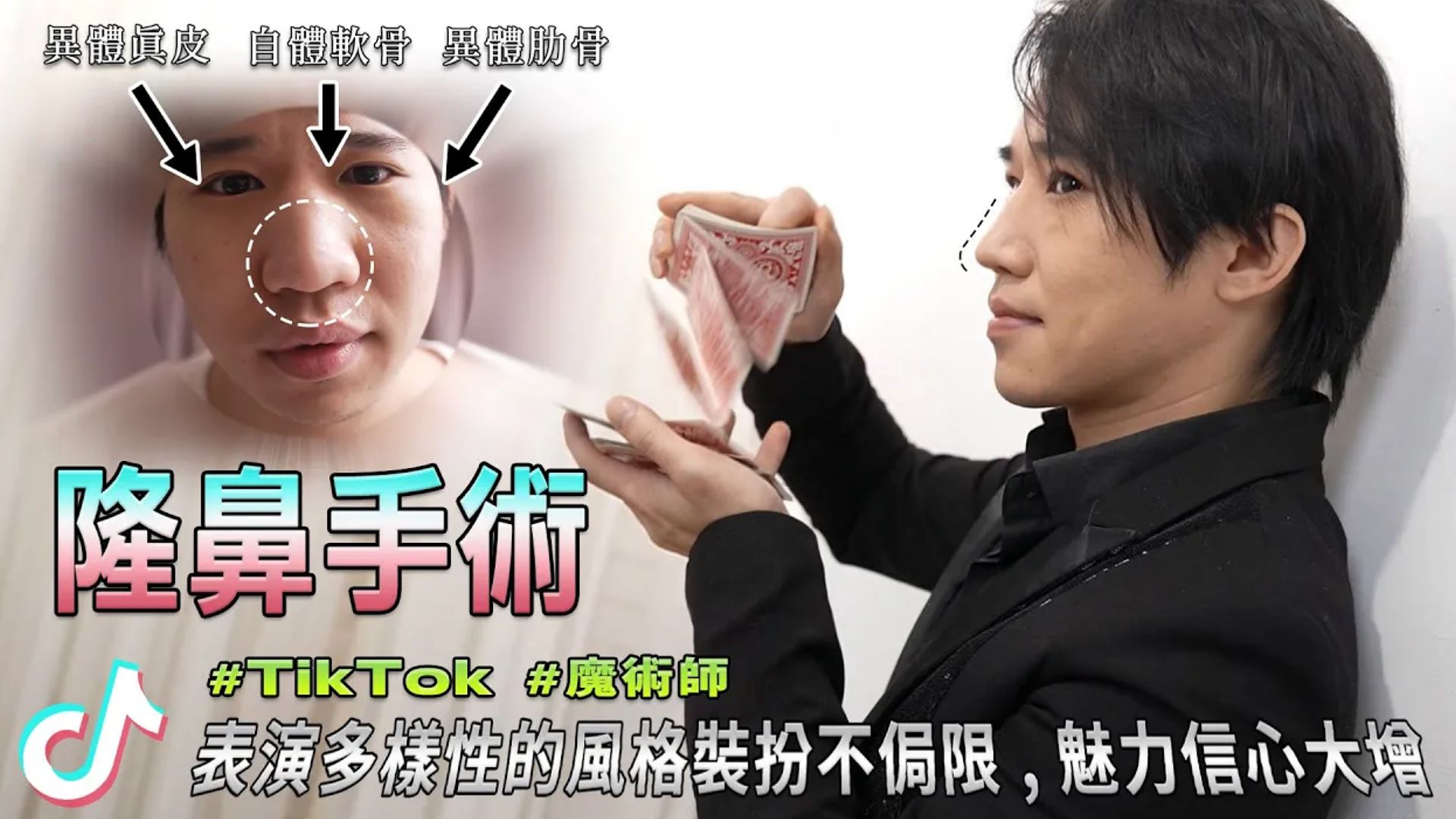 隆鼻手術 魔術師文懋氣場十足 異體真皮三段式隆鼻 改善扁塌鼻蒜頭鼻 台北亞緻 謝宇軒醫師