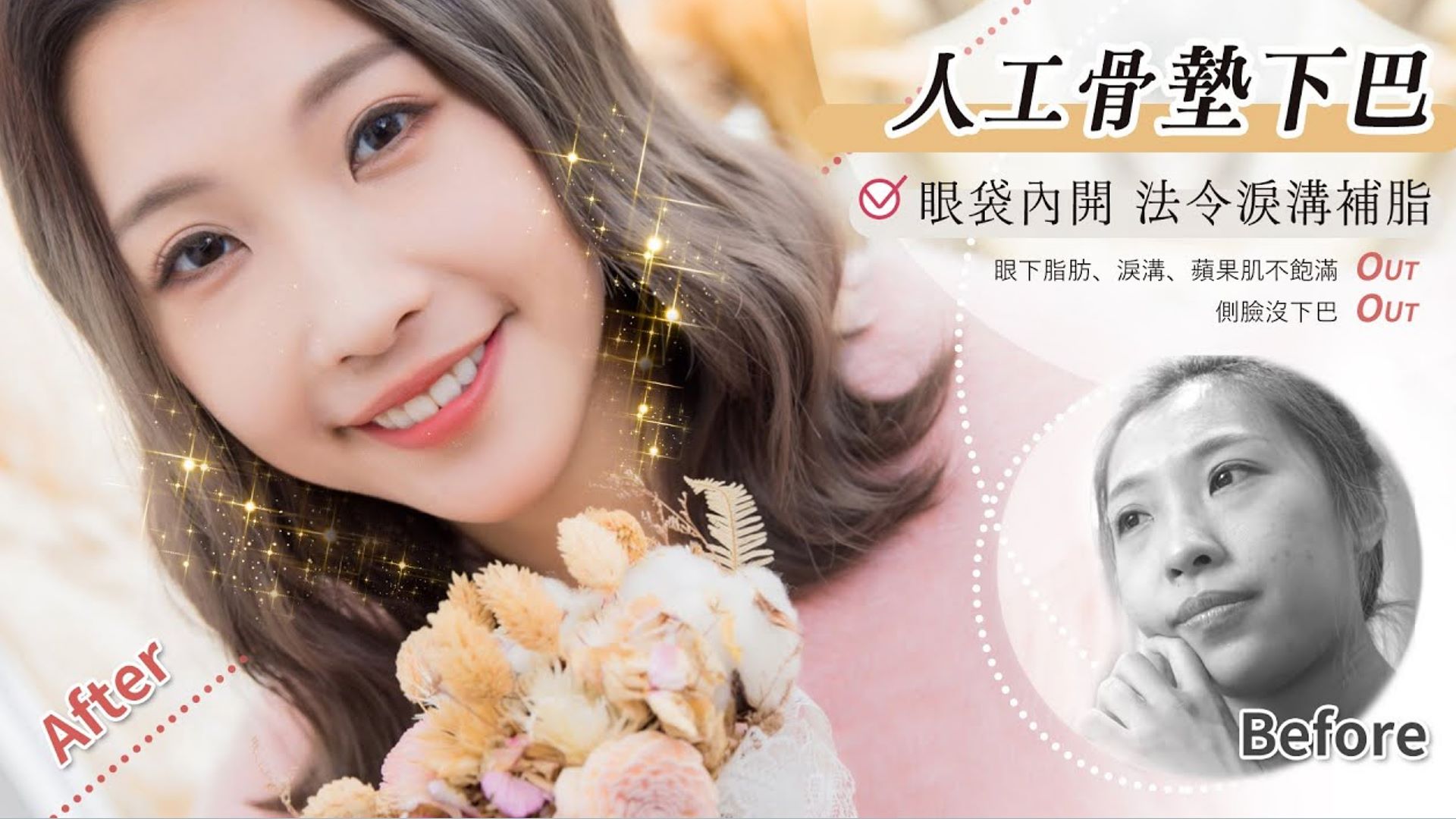 Emily靚麗奪目 ~ 眼袋內開合併自體脂肪淚溝法令紋蘋果肌補 人工骨下巴改善大小臉  台北亞緻TaipeiArts 謝宇軒醫師