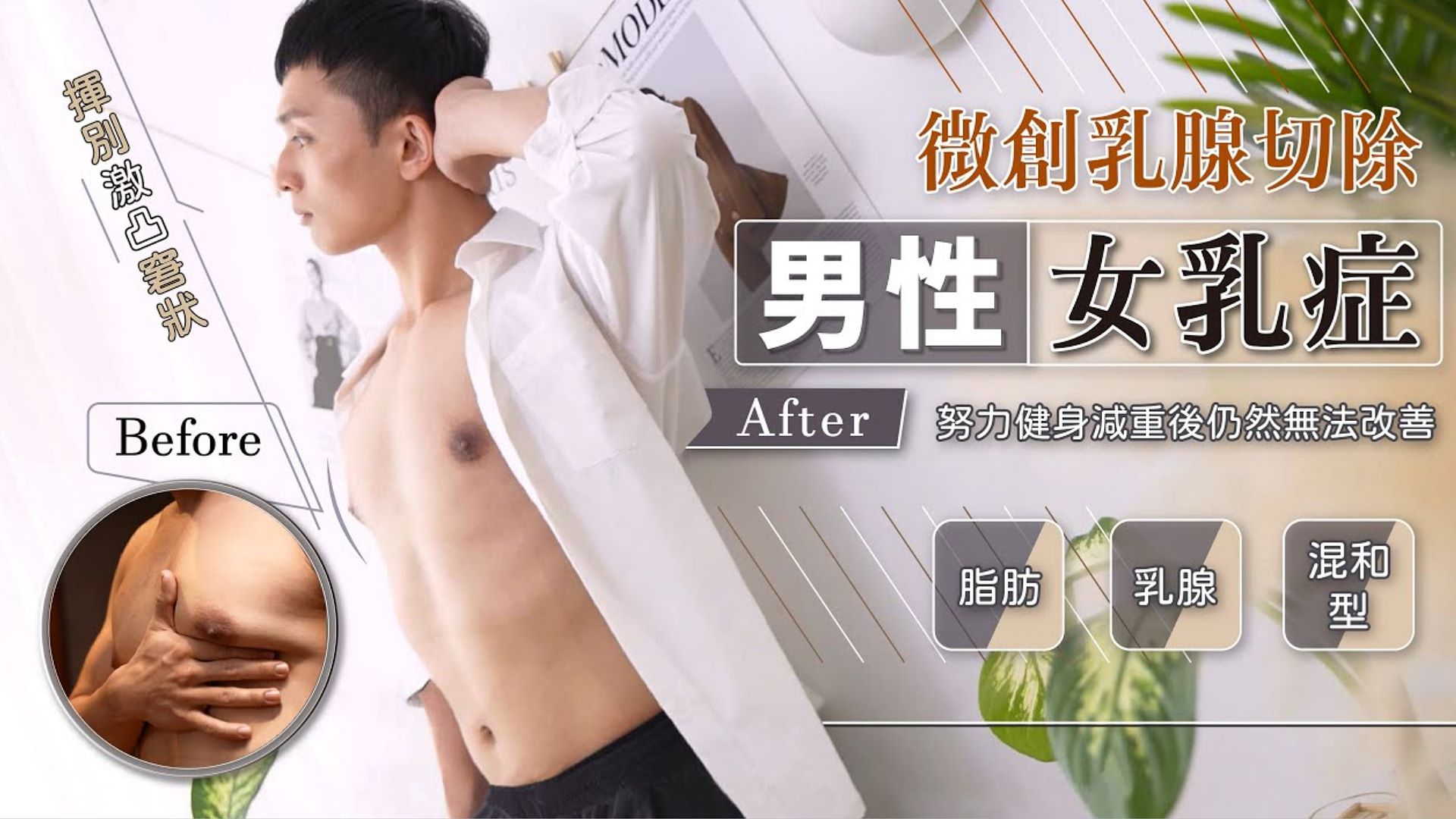 健身教練柑仔 揮別激凸窘狀 男性女乳症手術 改善男性女乳+乳腺切除  台北亞緻 女醫師賴雅薇