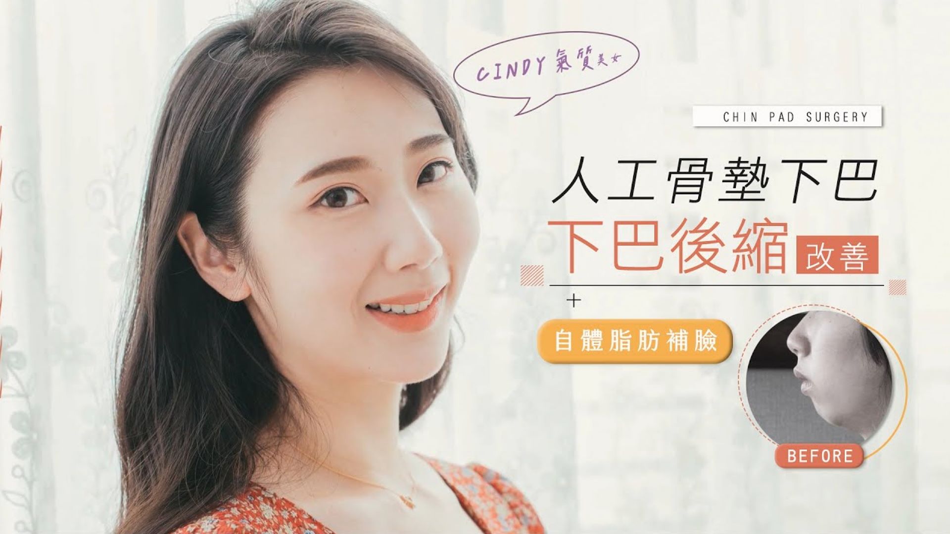 CINDY 下巴後縮大改造 變身氣質美女 人工骨墊下巴 自體脂肪補臉 台北亞緻 謝宇軒醫師